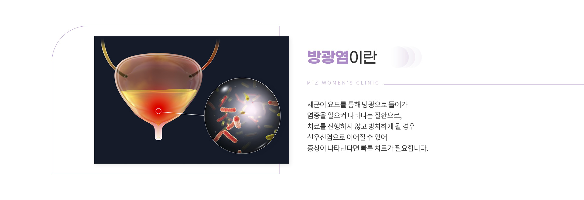 방광염 02