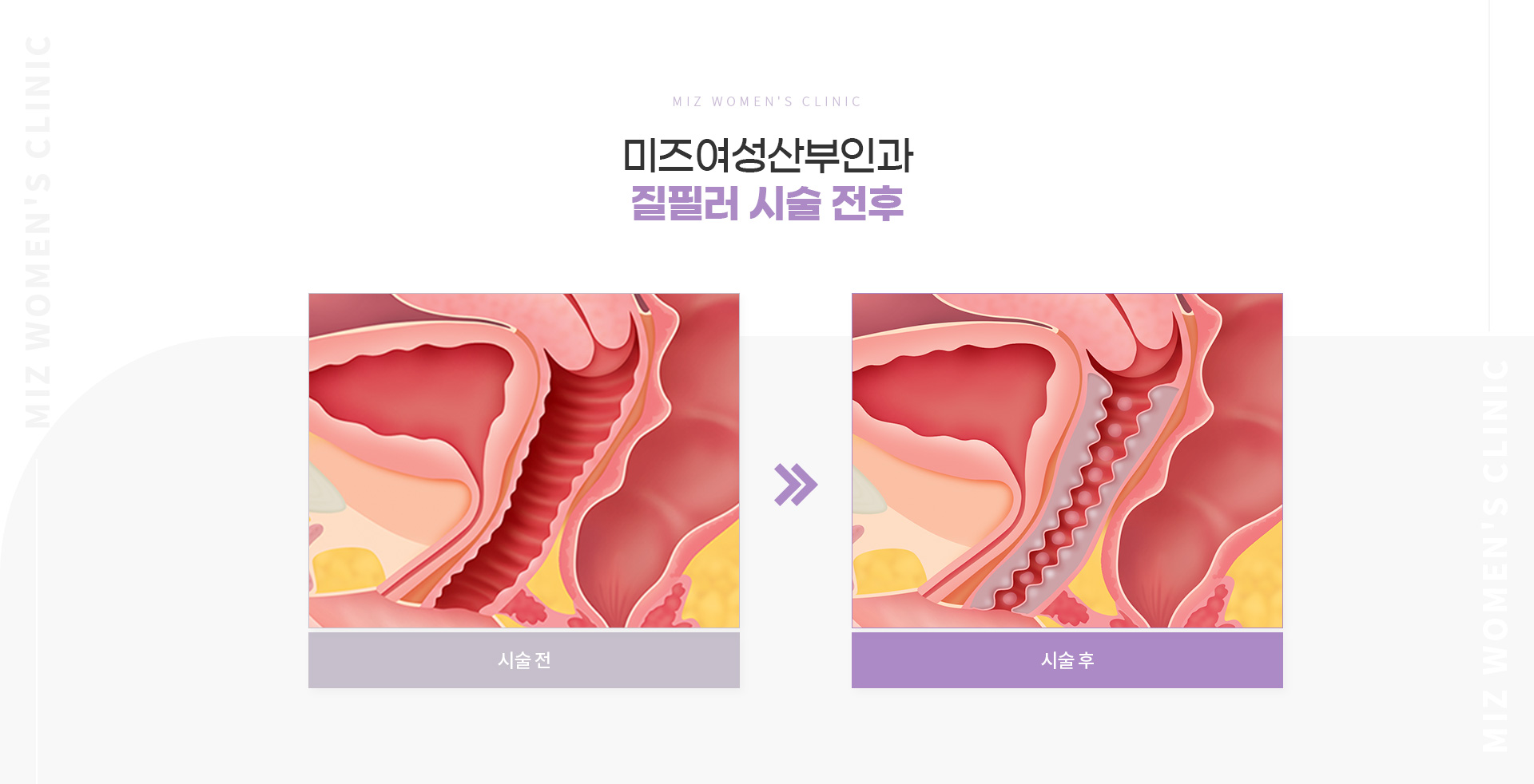 질필러 05