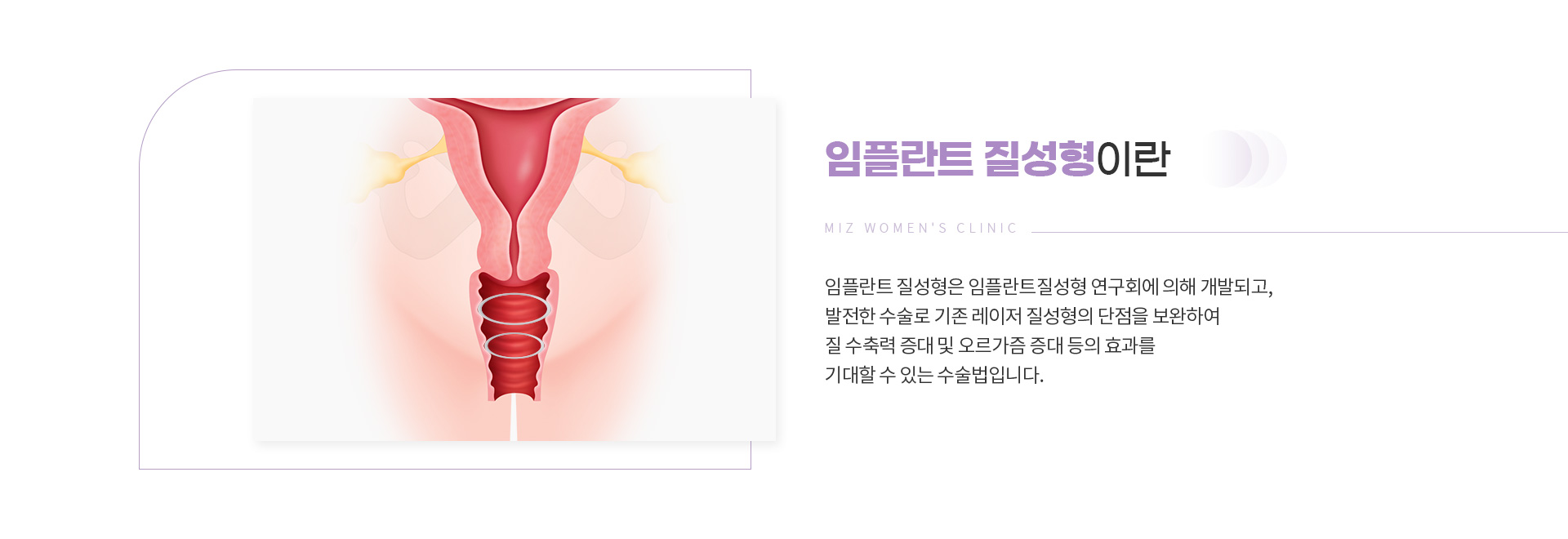미즈임플란트엠즐링/큐라클 02