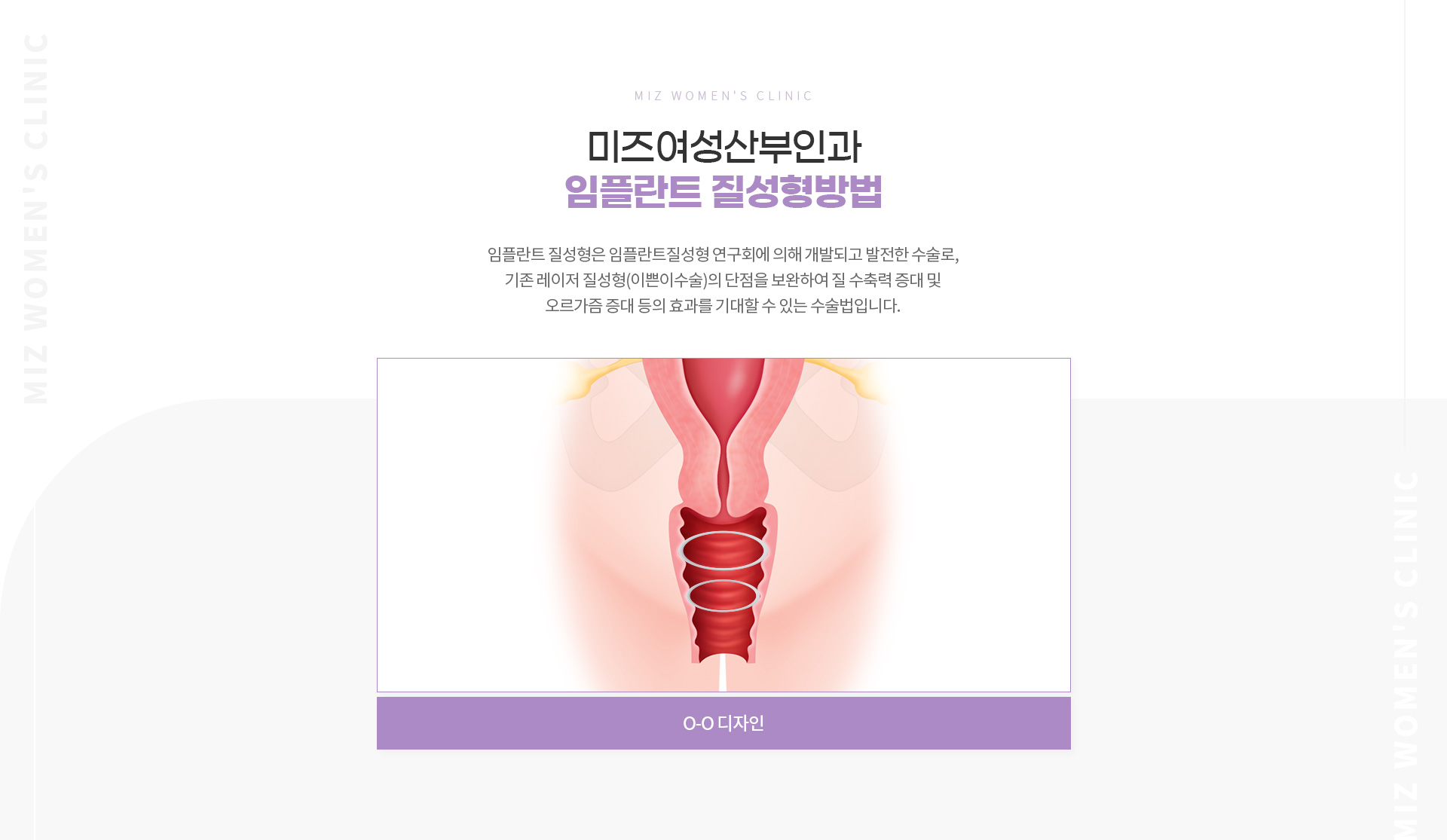미즈임플란트엠즐링/큐라클 05