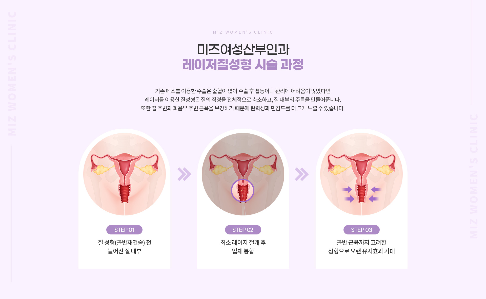 레이저질성형 04