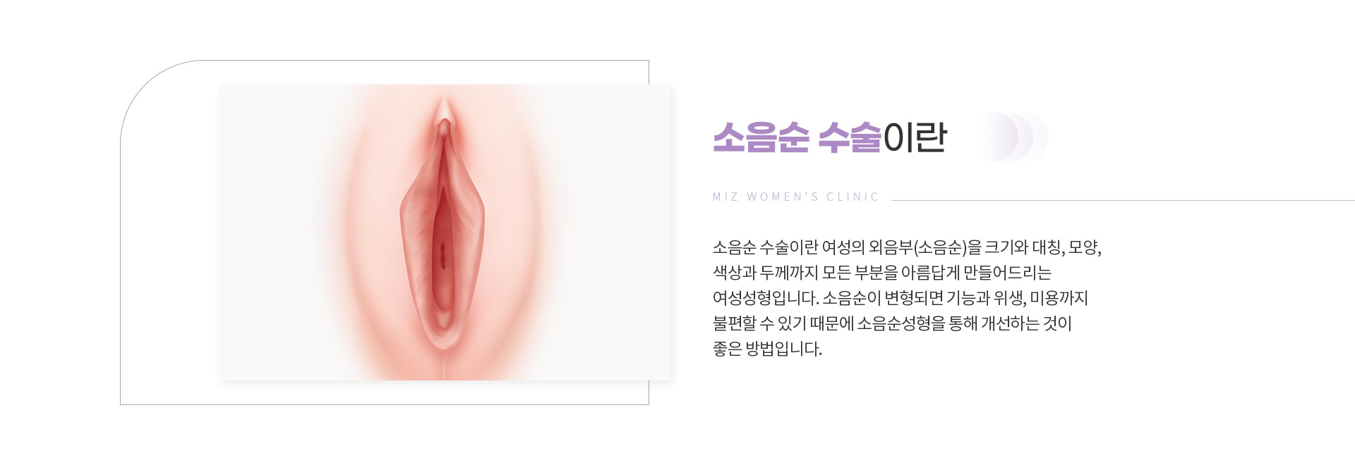 소음순수술 02