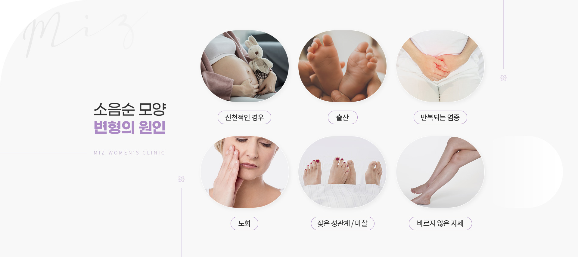 소음순수술 03
