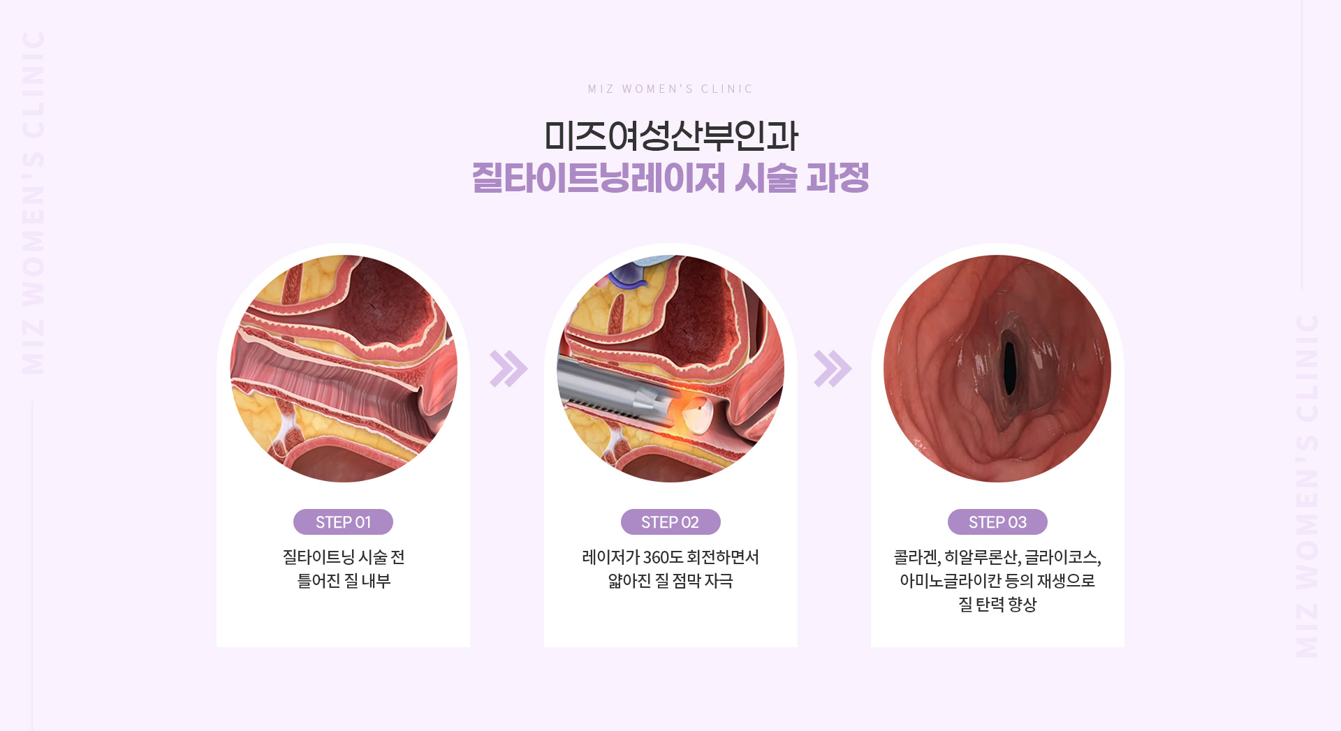 질타이트닝레이저 04