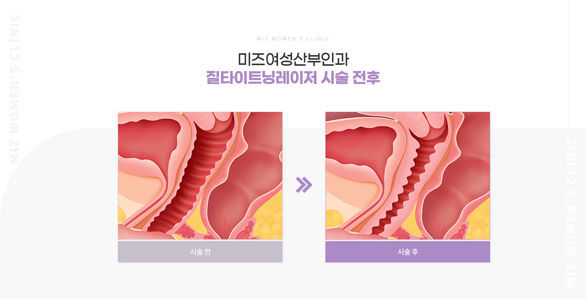 질타이트닝레이저 05